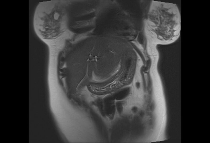 File:Chronic pancreatitis - pancreatic duct calculi (Radiopaedia 71818-82250 Coronal T2 25).jpg