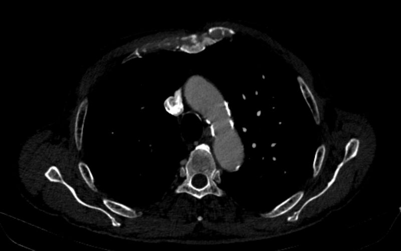 File:Chronic pulmonary embolism (Radiopaedia 91241-108843 B 56).jpg