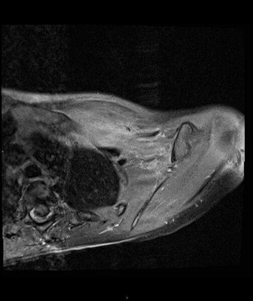 File:Chronic reactive multifocal osteomyelitis (CRMO) - clavicle (Radiopaedia 56406-63071 Axial T1 C+ fat sat 12).jpg