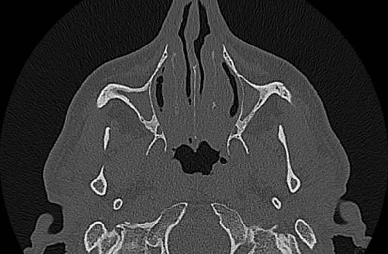 File:Chronic rhinosinusitis (Radiopaedia 65079-74075 Axial bone window 20).jpg