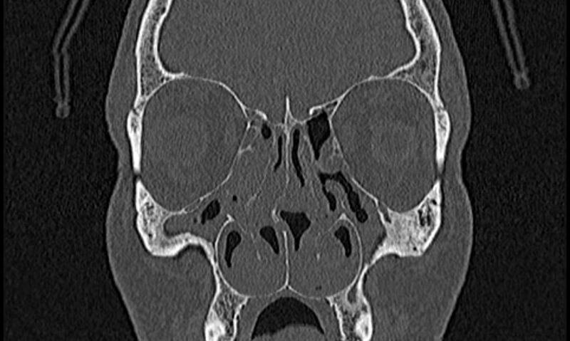 File:Chronic rhinosinusitis (Radiopaedia 65079-74075 Coronal bone window 30).jpg