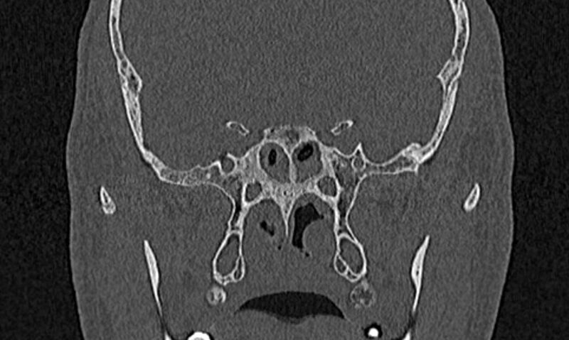 File:Chronic rhinosinusitis (Radiopaedia 65079-74075 Coronal bone window 66).jpg