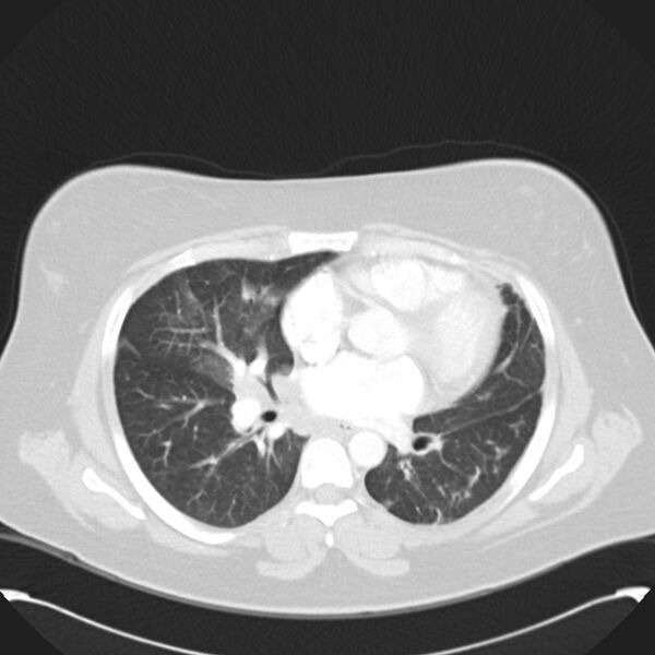File:Chronic thromboembolic pulmonary hypertension (CTEPH) (Radiopaedia 74597-85531 Axial lung window 28).jpg