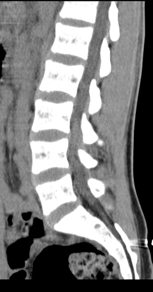 File:Clear cell meningoma - lumbar spine (Radiopaedia 60116-67691 A 24).png