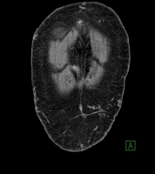 File:Closed-loop small bowel obstruction-internal hernia (Radiopaedia 78439-91096 Coronal non-contrast 15).jpg