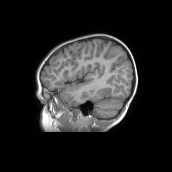 File:Cochlear nerve aplasia - unilateral (Radiopaedia 87910-104413 Sagittal T1 12).jpg