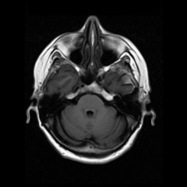 File:Colloid cyst with hydrocephalus (Radiopaedia 9373-10065 Axial T1 5).jpg