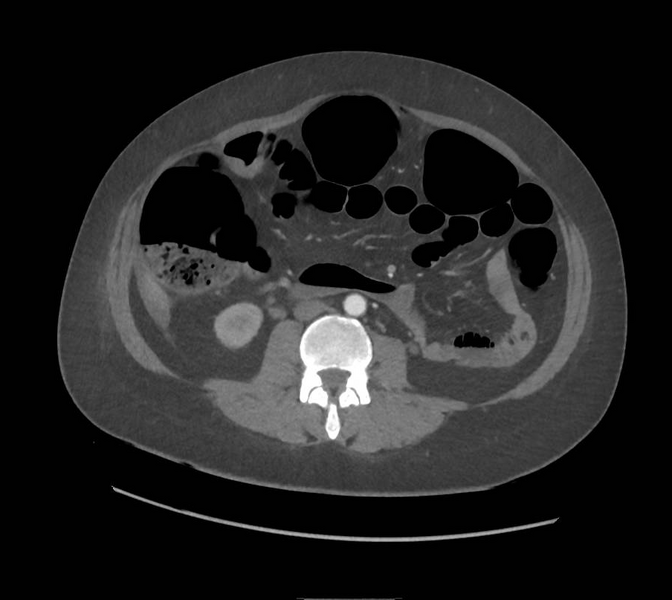 File:Colonic pseudo-obstruction (Radiopaedia 79752-92980 A 100).png