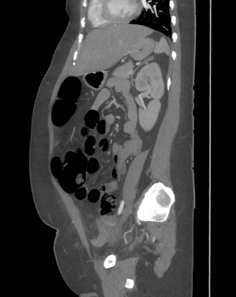 File:Colonic pseudo-obstruction (Radiopaedia 79752-92980 C 50).png