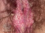 Herpes simplex (DermNet NZ viral-genital-herpes-2-s).jpg