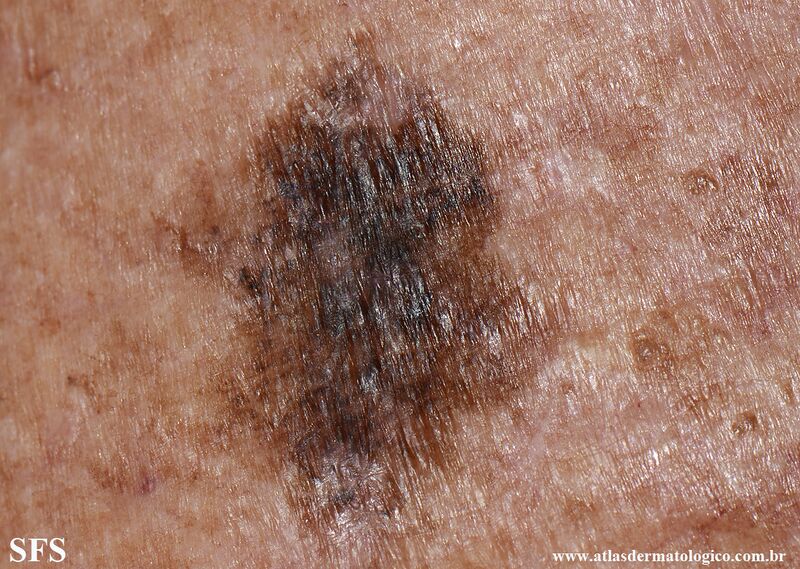 File:Melanoma (Dermatology Atlas 124).jpg