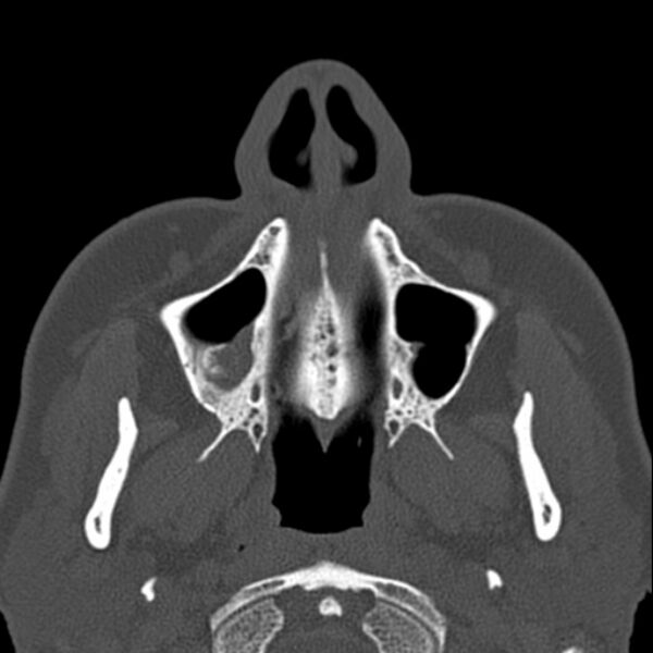 File:Nasal septal perforation (Radiopaedia 25030-25289 Axial bone window 5).jpg