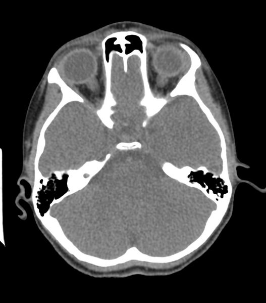 File:Nasoorbitoethmoid fracture (Radiopaedia 90044-107205 Axial non-contrast 170).jpg