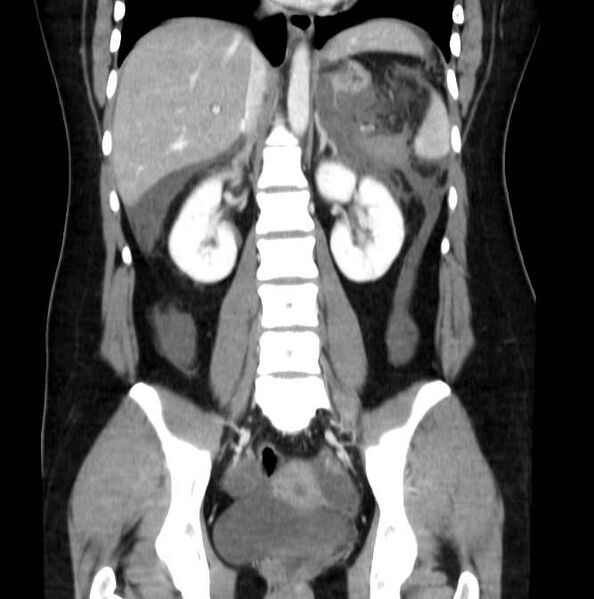 File:Necrotizing pancreatitis (Radiopaedia 23001-23031 B 42).jpg