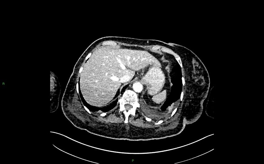 Neo-terminal ileal stricture (Crohn disease) (Radiopaedia 33790-34948 A 66).jpg