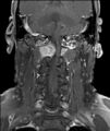 Neurofibromatosis type 1 (Radiopaedia 80355-93740 I 8).jpg