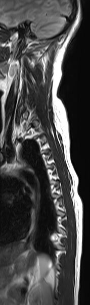 File:Neurofibromatosis type 2 (Radiopaedia 66211-75403 Sagittal T2 12).jpg