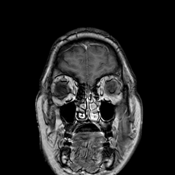 File:Neurofibromatosis type 2 (Radiopaedia 67470-76871 Coronal T1 C+ 5).jpg