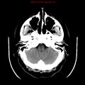 Neuroglial cyst (Radiopaedia 10713-11185 Axial non-contrast 27).jpg