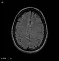 Neurosarcoidosis (Radiopaedia 10930-17204 Axial FLAIR 15).jpg