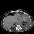Non Hodgkin lymphoma in a patient with ankylosing spondylitis (Radiopaedia 84323-99621 Axial non-contrast 26).jpg