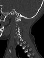 Normal CT cervical spine - pediatric (Radiopaedia 52549-58462 Sagittal bone window 25).jpg
