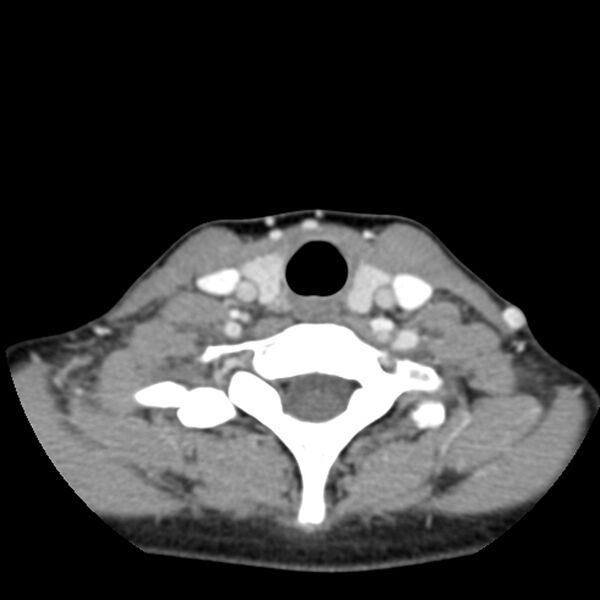 File:Normal CT of the neck (Radiopaedia 14575-14500 Axial C+ 52).jpg
