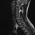 Normal cervical spine MRI (Radiopaedia 38418-40496 Sagittal T2 11).jpg