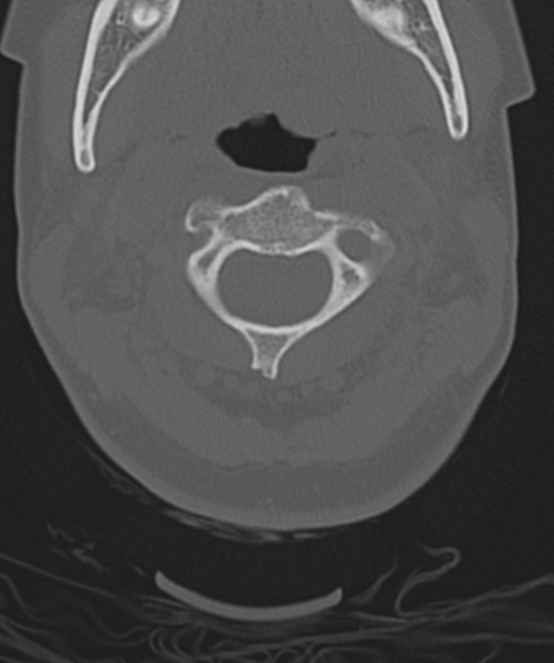 File:Normal cervical spine MRI (including Dixon) (Radiopaedia 42762-45926 Axial bone window 17).png