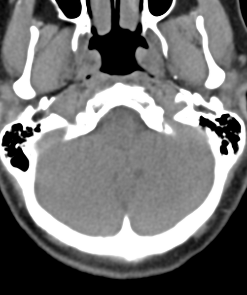 File:Normal cervical spine MRI (including Dixon) (Radiopaedia 42762-45926 Axial non-contrast 5).png