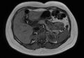 Normal liver MRI with Gadolinium (Radiopaedia 58913-66163 B 19).jpg