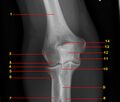 Normal radiographic anatomy of the elbow (Radiopaedia 42757-45918 Frontal 1).jpg