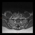 Normal spine MRI (Radiopaedia 77323-89408 Axial T1 29).jpg