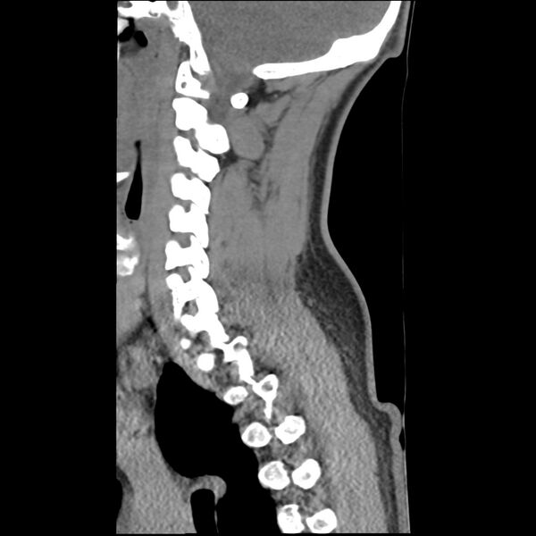 File:Normal trauma spine imaging (Radiopaedia 31753-32686 A 13).jpg