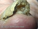 Onychomycosis, toenail (DermNet NZ Onychomycosis-0).jpg
