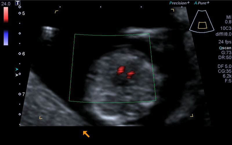 File:1st trimester nuchal-morphology ultrasound (Radiopaedia 44706-48477 Heart views cine with colour 101).jpg