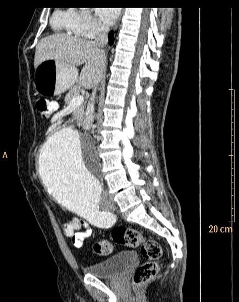 File:Abdominal aortic aneurysm (Radiopaedia 25985-26121 Sagittal C+ arterial phase 19).jpg
