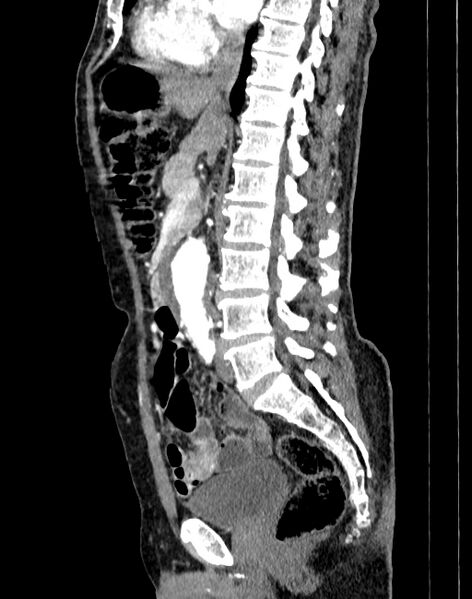 File:Abdominal aortic aneurysm (Radiopaedia 83581-98689 Sagittal C+ arterial phase 38).jpg