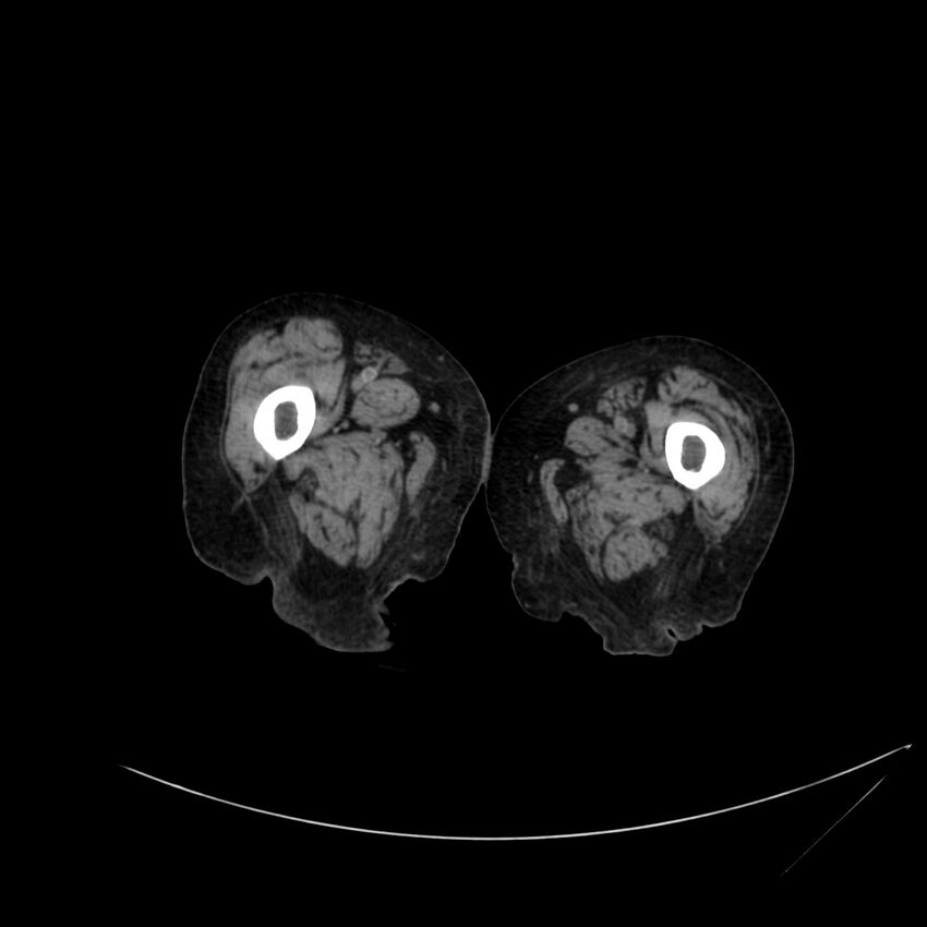 Abdominal aortic aneurysm - impending rupture (Radiopaedia 19233-19246 Axial non-contrast 155).jpg