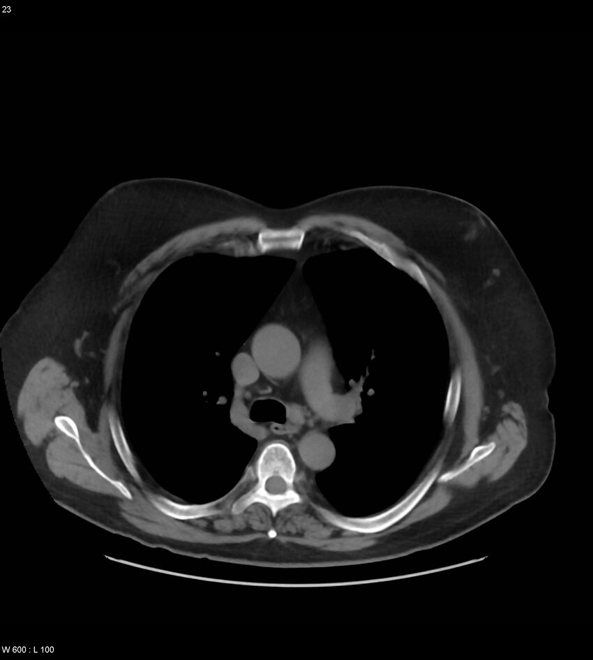 Abdominal aortic aneurysm with intramural hematoma then rupture (Radiopaedia 50278-55631 Axial non-contrast 19).jpg