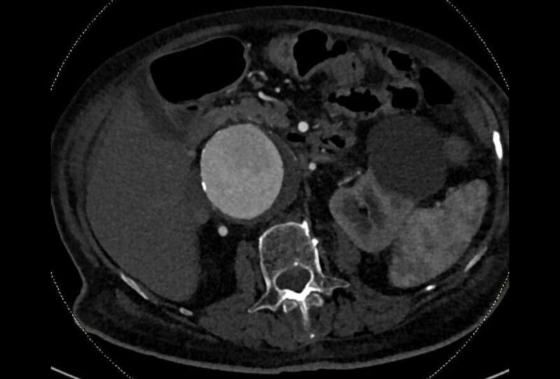 File:Abdominal aortic aneurysm with thrombus fissuration (Radiopaedia 73192-83919 Axial C+ arterial phase 58).jpg