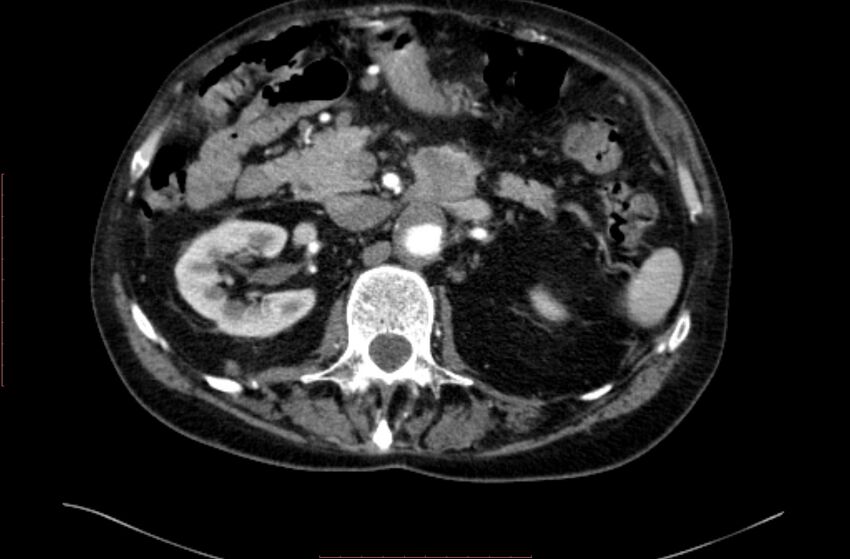 Abdominal aortic interposition tube graft and aneurysm thrombosis (Radiopaedia 71438-81857 Axial C+ arterial phase 42).jpg