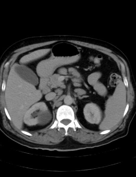 File:Abdominal lymphoma - with sandwich sign (Radiopaedia 53486-59492 Axial C+ portal venous phase 16).jpg
