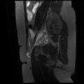 Abdominal wall endometriosis (Radiopaedia 83702-98847 Sagittal T2 fat sat 15).jpg
