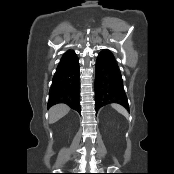 File:Aberrant right subclavian and left vertebral arteries (Radiopaedia 43467-46847 Coronal C+ portal venous phase 70).jpg