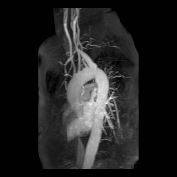 File:Aberrant right subclavian artery with background Takayasu arteritis (Radiopaedia 21423-21363 MRA 1).jpg