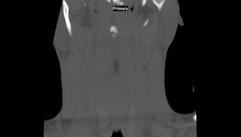 File:Accessory ossicle of the anterior arch of C1 vertebra (Radiopaedia 58149-65211 Coronal bone window 1).jpg