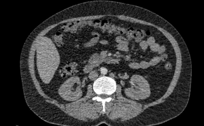 Accessory right inferior hepatic vein (Radiopaedia 65245-74259 Axial C+ arterial phase 84).jpg