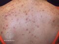 Acne affecting the back images (DermNet NZ acne-acne-back-182).jpg