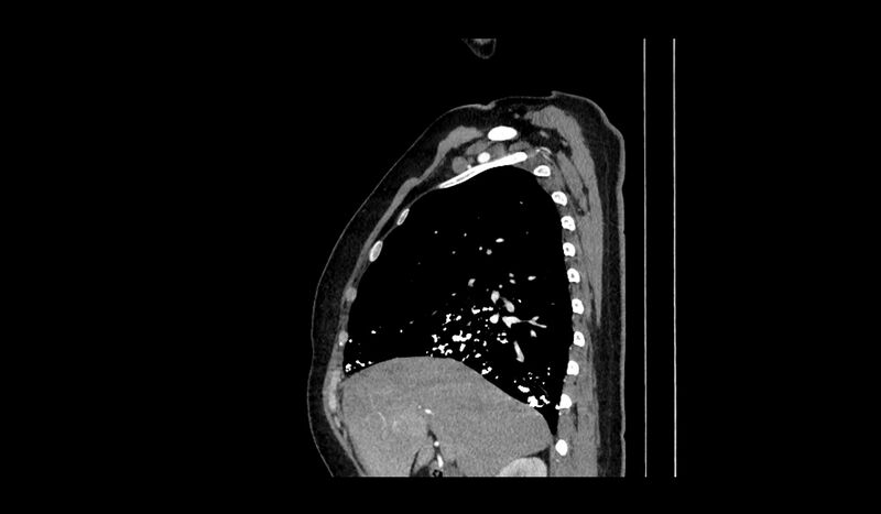 File:Acquired tracheo-esophageal fistula (Radiopaedia 51356-57103 Sagittal C+ arterial phase 12).jpg